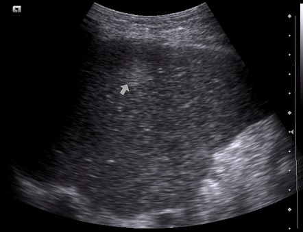 Ultrasound guided liver biopsy | Image | Radiopaedia.org