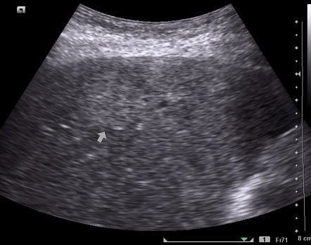 Ultrasound guided liver biopsy | Image | Radiopaedia.org