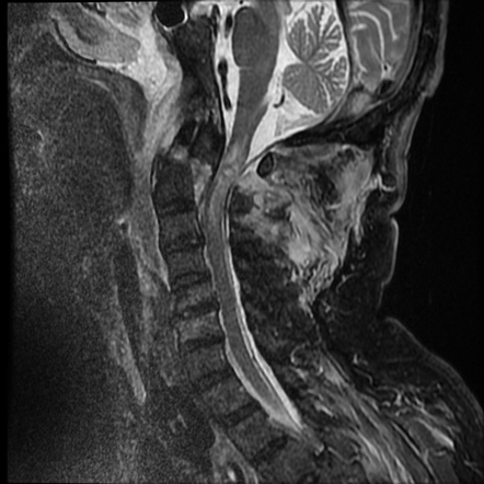 Dens fracture with atlantoaxial subluxation and cord hemorrhage | Image ...