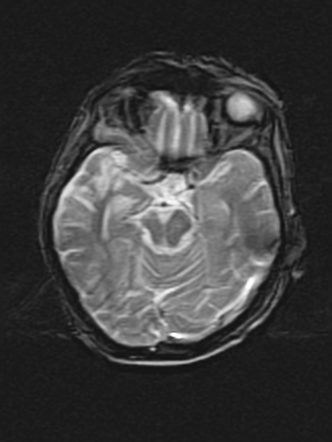 Wallerian degeneration | Radiology Reference Article | Radiopaedia.org