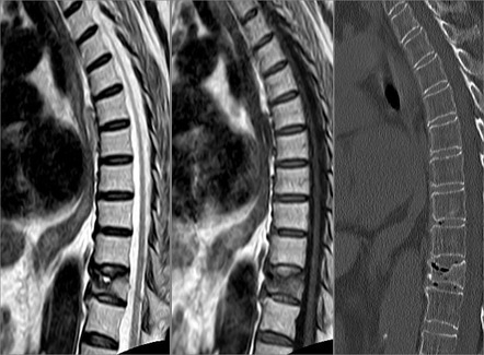 MRI of the dorso-lumbar spine showing a partial collapse of the D12