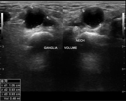 Scapholunate ganglion cyst | Image | Radiopaedia.org