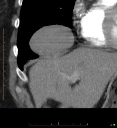 Focal diaphragmatic hernia containing liver | Radiology Case ...