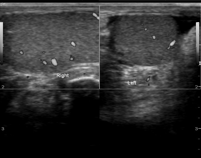 Scrotal Hernia Ultrasound