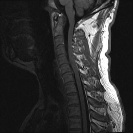 Neurofibromatosis type 1 - with brachial plexus neurofibroma | Image ...