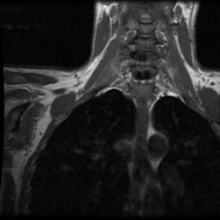 Brachial Plexus Post Ganglionic Root Avulsion Radiology Case My XXX Hot Girl