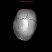 Scaphocephaly | Radiology Reference Article | Radiopaedia.org