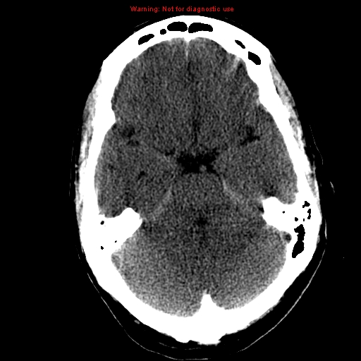 does-a-ct-scan-show-anoxic-brain-injury-ct-scan-machine-my-xxx-hot-girl