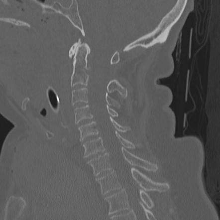 Type III odontoid fracture | Image | Radiopaedia.org