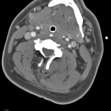 Blunt Cerebrovascular Injury Radiology Reference Article