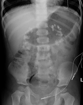 Medullary nephrocalcinosis | Radiology Reference Article | Radiopaedia.org