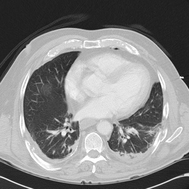 can small cell lung cancer spread to the brain