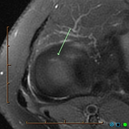 Radial meniscal tear | Radiology Reference Article | Radiopaedia.org