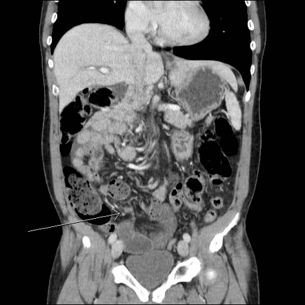 Intestinal malrotation | Image | Radiopaedia.org