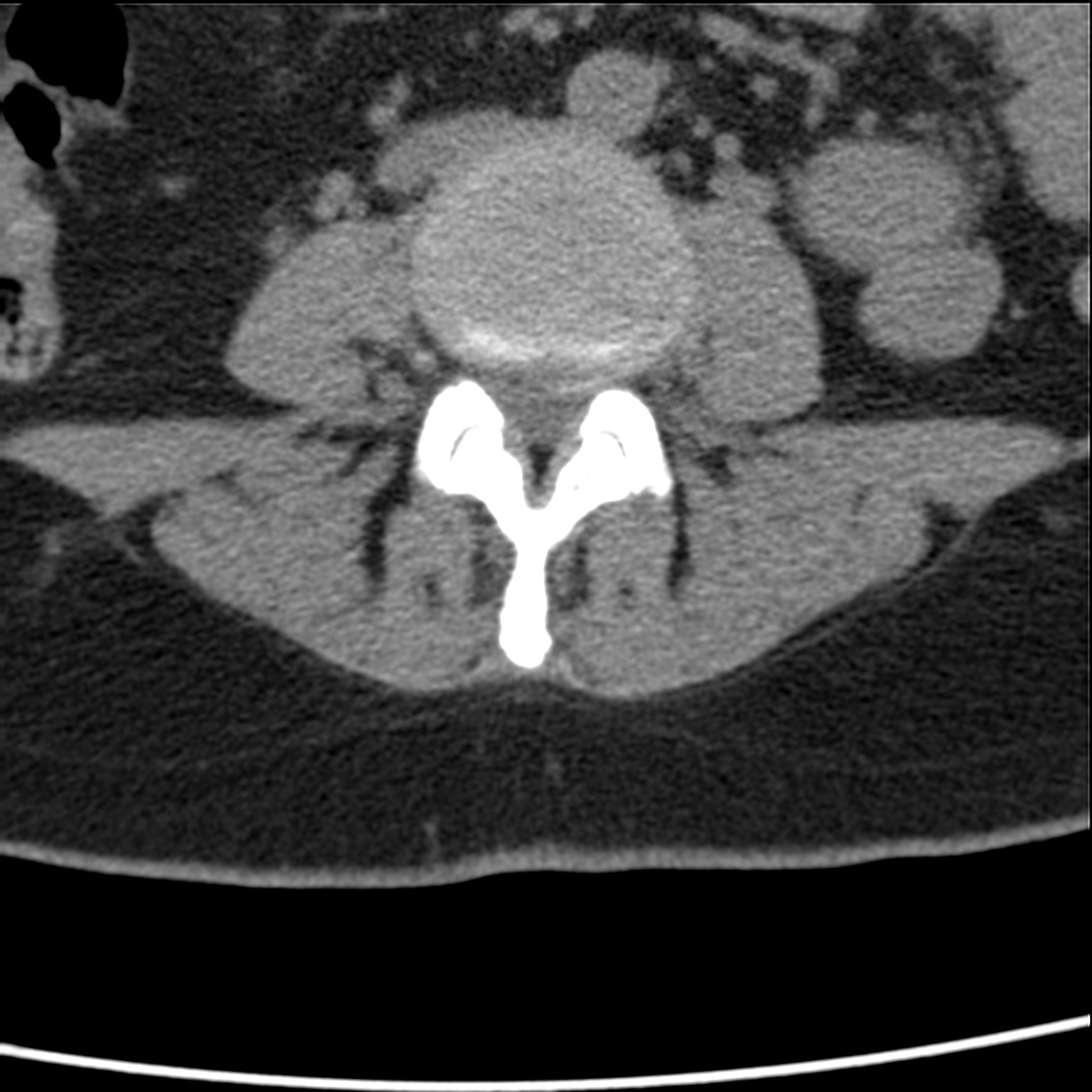 Disc Bulge And Focal Disc Protrusion Image