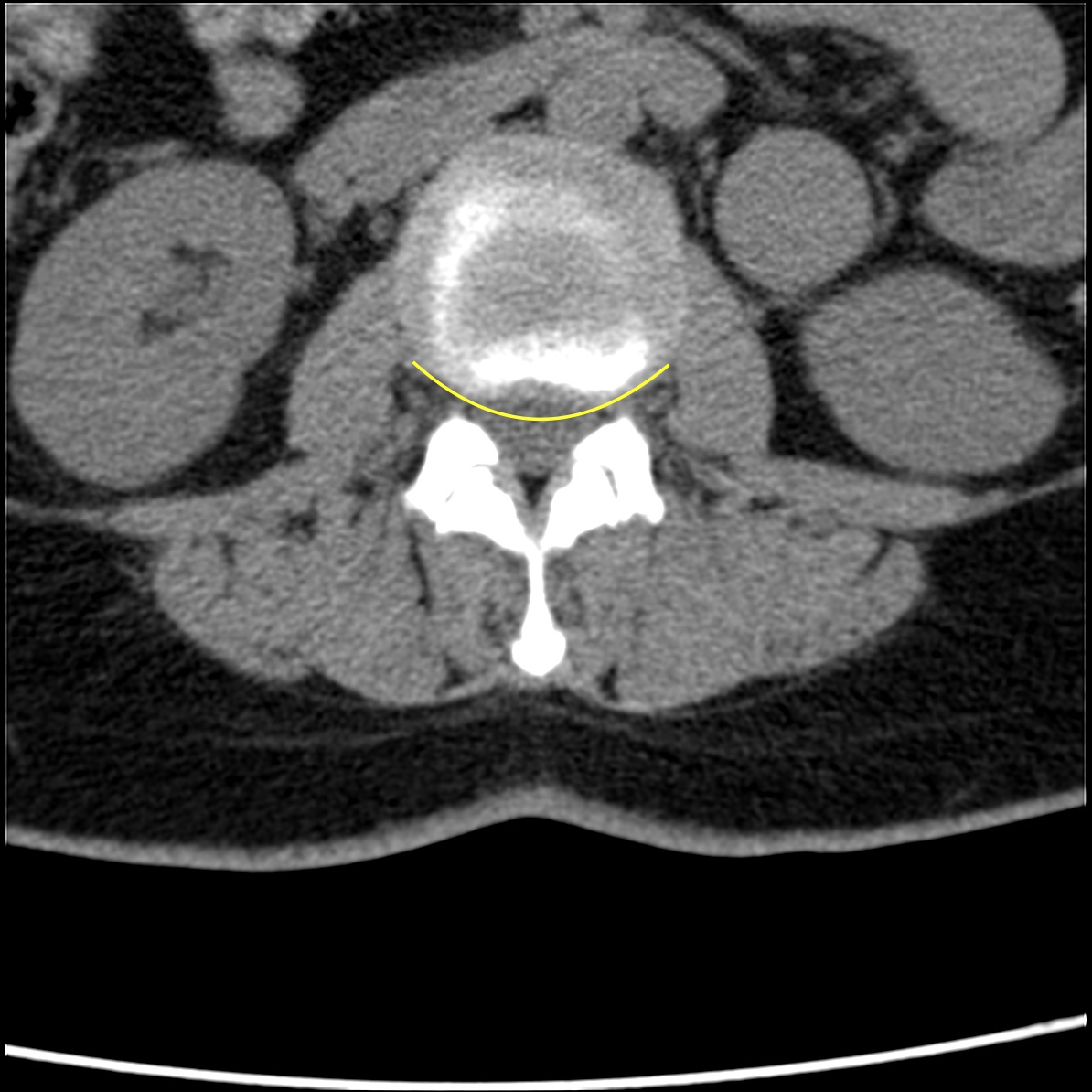 Disc bulge and focal disc protrusion | Image | Radiopaedia.org