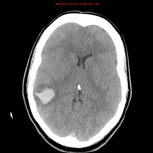 Dural sinus thrombosis and venous infarction | Image | Radiopaedia.org