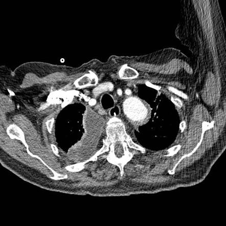 Pleural fluid (summary) | Radiology Reference Article | Radiopaedia.org