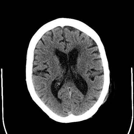 Subtle subdural hemorrhage and frontal contusion in trauma patient ...