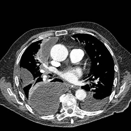 Empyema | Radiology Case | Radiopaedia.org