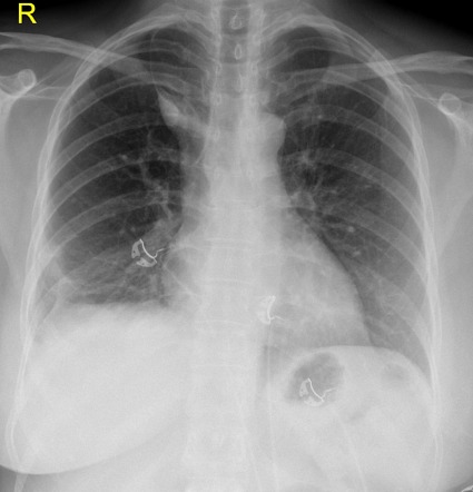 Enlarged azygos vein | Radiology Reference Article | Radiopaedia.org