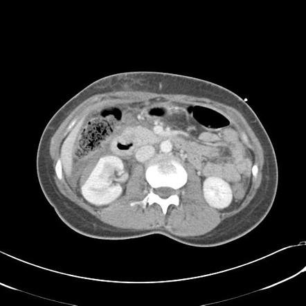 AAST kidney injury scale | Radiology Reference Article | Radiopaedia.org