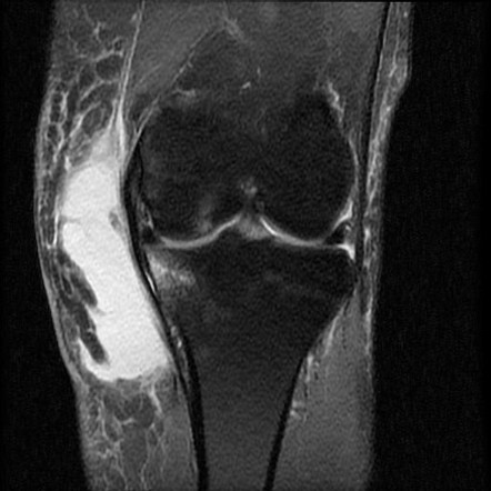 Morel-Lavallée lesion of knee with osteochondral fractures | Radiology ...