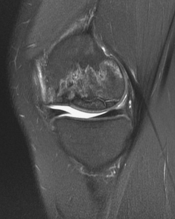 Avascular Necrosis Knee Mri