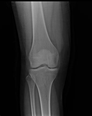 Anterior cruciate ligament bony avulsion | Radiology Case | Radiopaedia.org