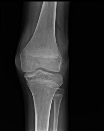 Foreign body induced knee synovitis | Image | Radiopaedia.org