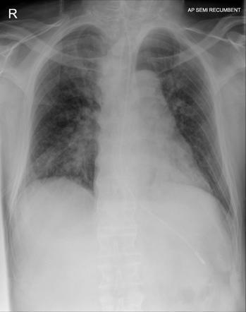 Acute unilateral airspace opacification (differential) | Radiology ...