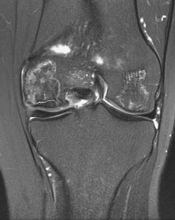 Avascular Necrosis Knee Mri