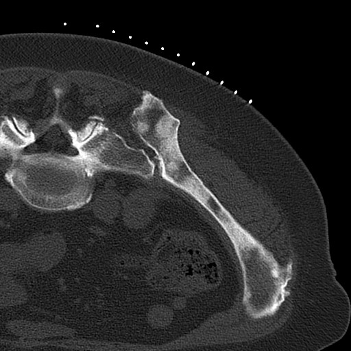 Dural Metastases Mimicking Meningiomas | Image | Radiopaedia.org