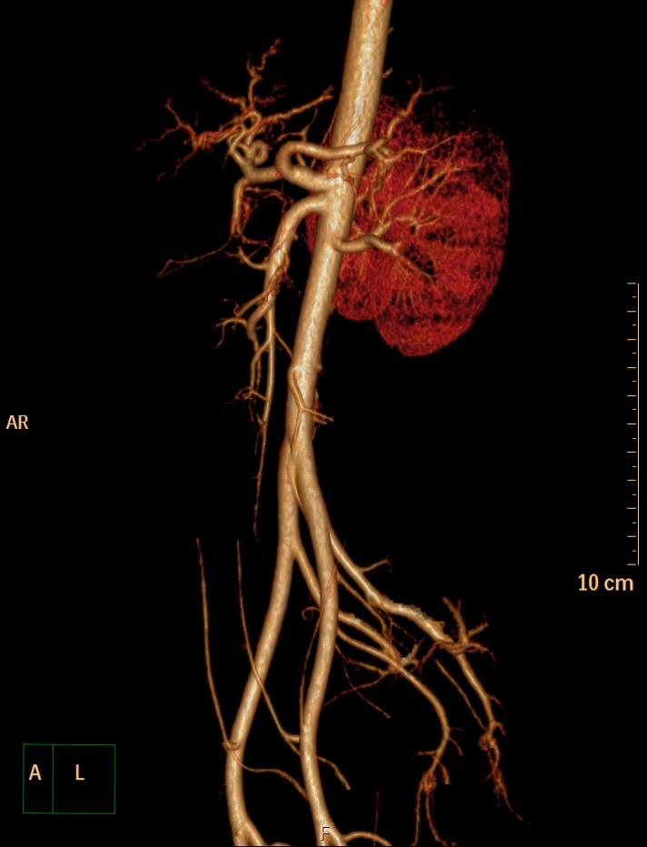 Normal CT angiography of the splanchnic vessels | Image | Radiopaedia.org