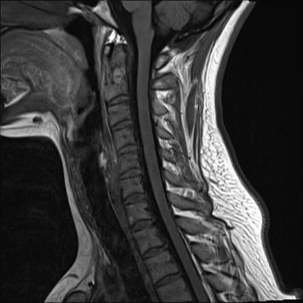 Normal trauma cervical spine MRI | Image | Radiopaedia.org