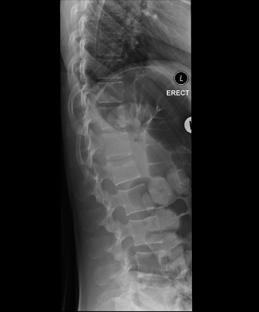 L1 burst fracture | Radiology Case | Radiopaedia.org