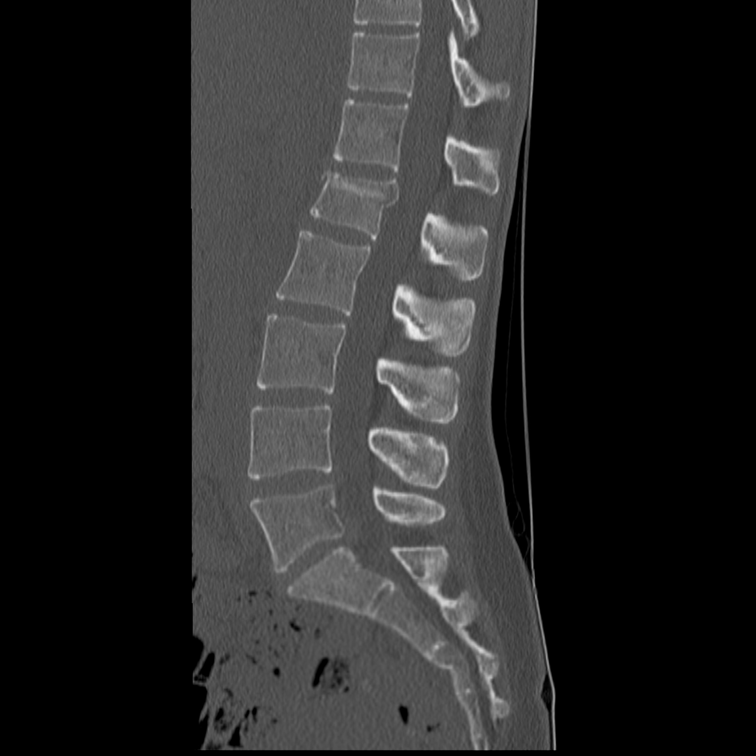 airo ct for lumbar spine