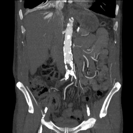 Aortoiliac occlusive disease | Radiology Reference Article ...