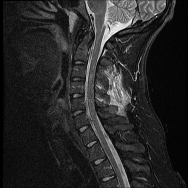 Discoligamentous injury, Radiology Reference Article