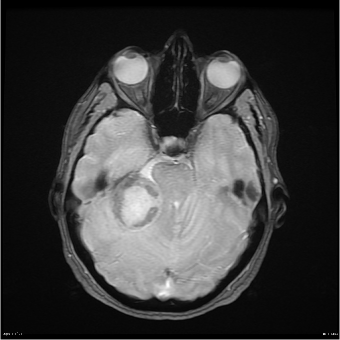 Cerebellopontine angle meningioma with two distinct parts | Image ...