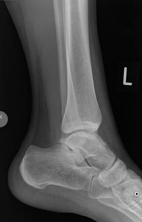 Hidden fibular fracture | Radiology Case | Radiopaedia.org