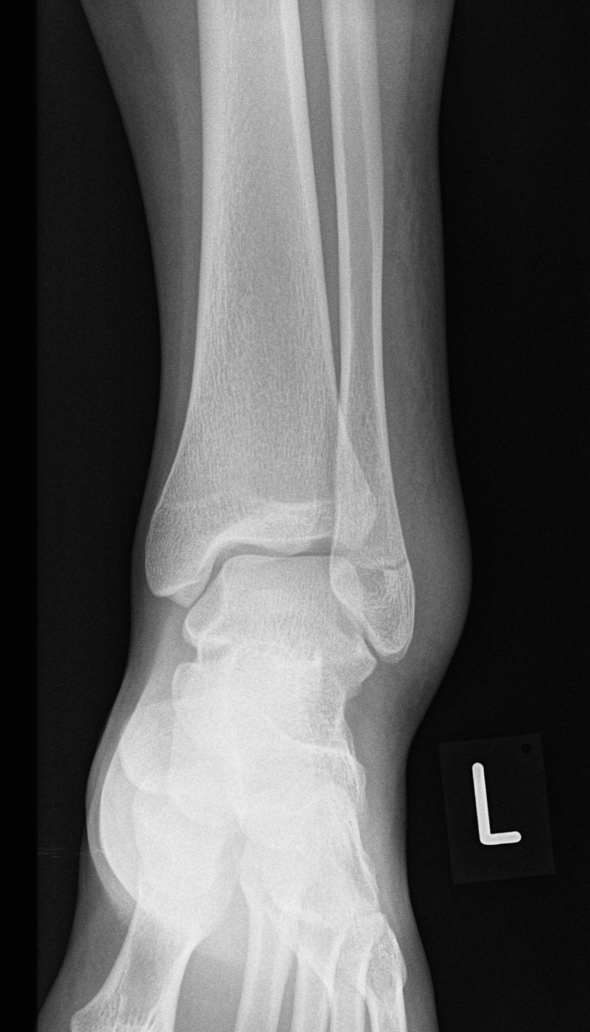 Hidden fibular fracture | Image | Radiopaedia.org