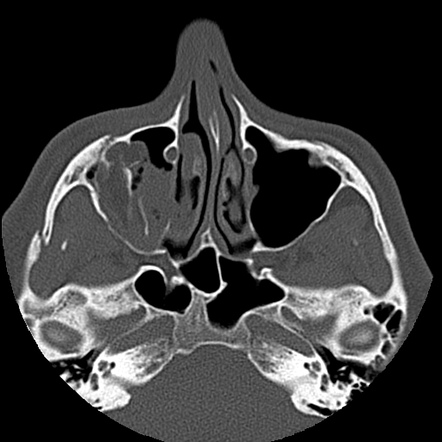 Zygomaticomaxillary Complex Fracture Radiology Reference Article