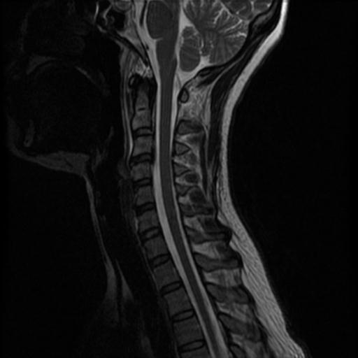 Hangman's fracture | Image | Radiopaedia.org