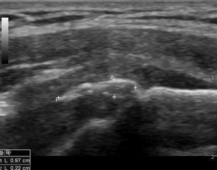 Calcific tendinosis of supraspinatus tendon | Radiology Case ...