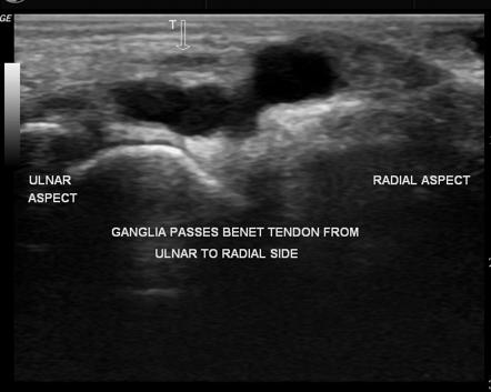 Ganglion cyst | Radiology Reference Article | Radiopaedia.org