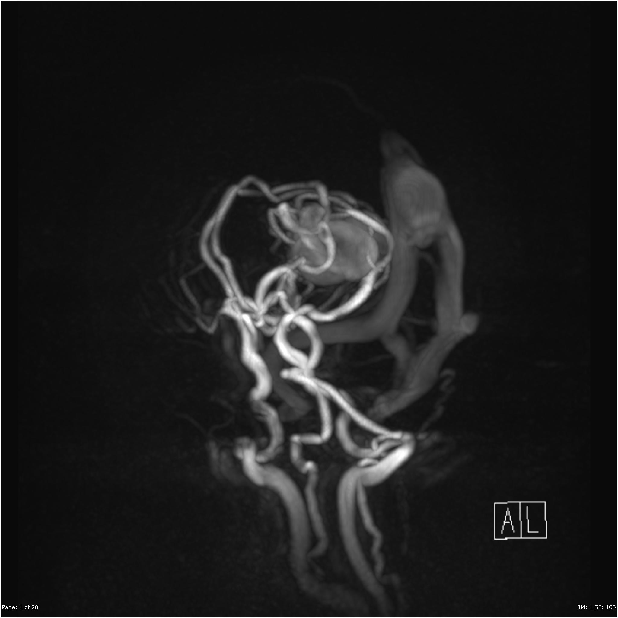 Vein Of Galen Malformation Image