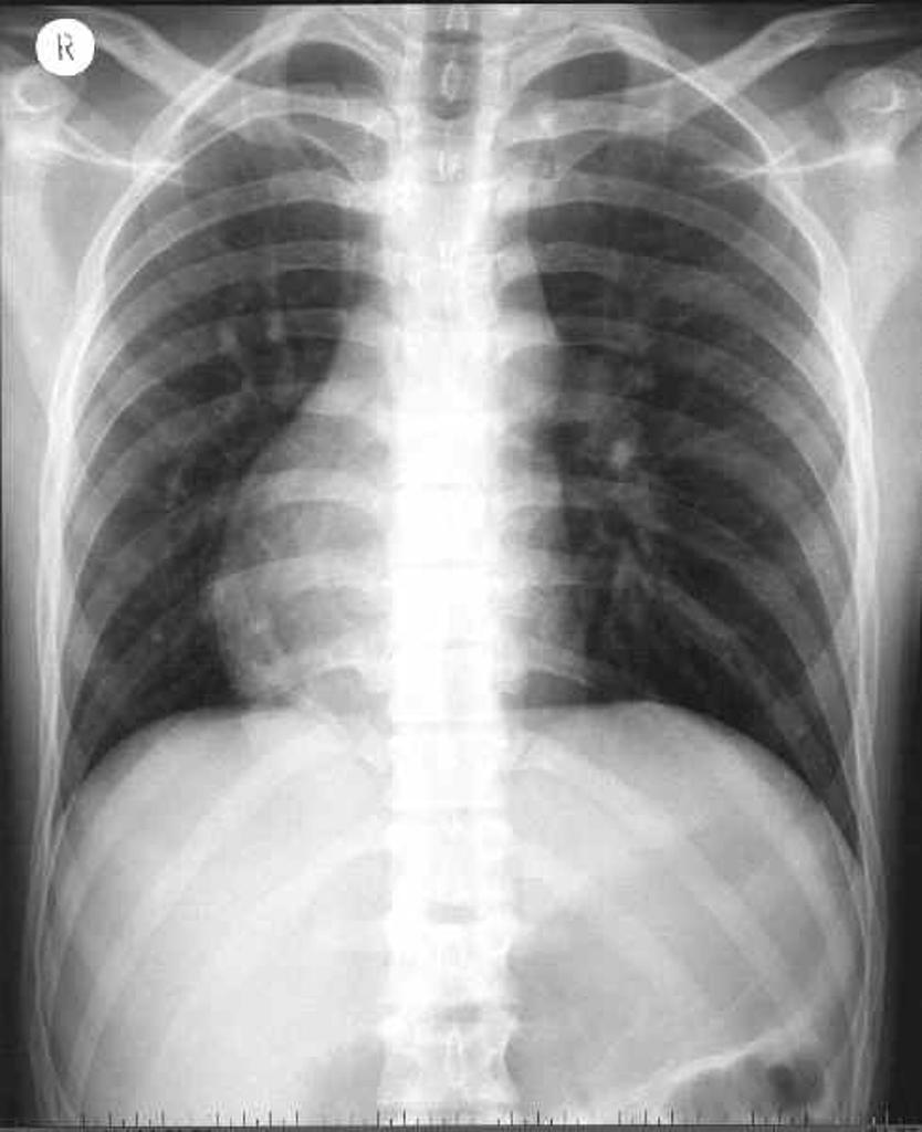 Dextrocardia Radiology Case Radiopaedia Org