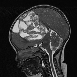 Embryonal tumor with multilayered rosettes (ETMR) | Image | Radiopaedia.org