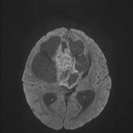 Embryonal tumor with multilayered rosettes (ETMR) | Image | Radiopaedia.org